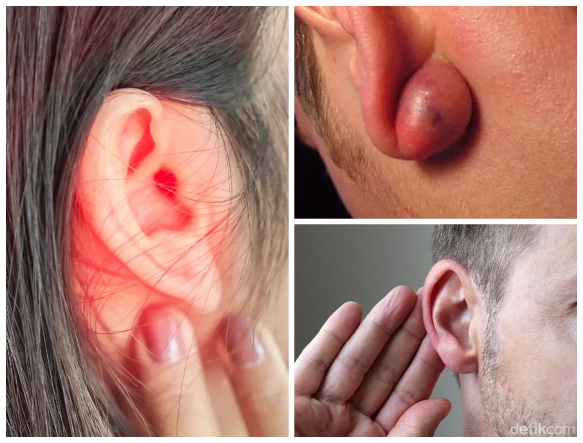 Mengetahui Berbagai Jenis Benjolan di Telinga: Penyebab, Ciri-Ciri, dan Cara Mengatasinya Secara Tepat!