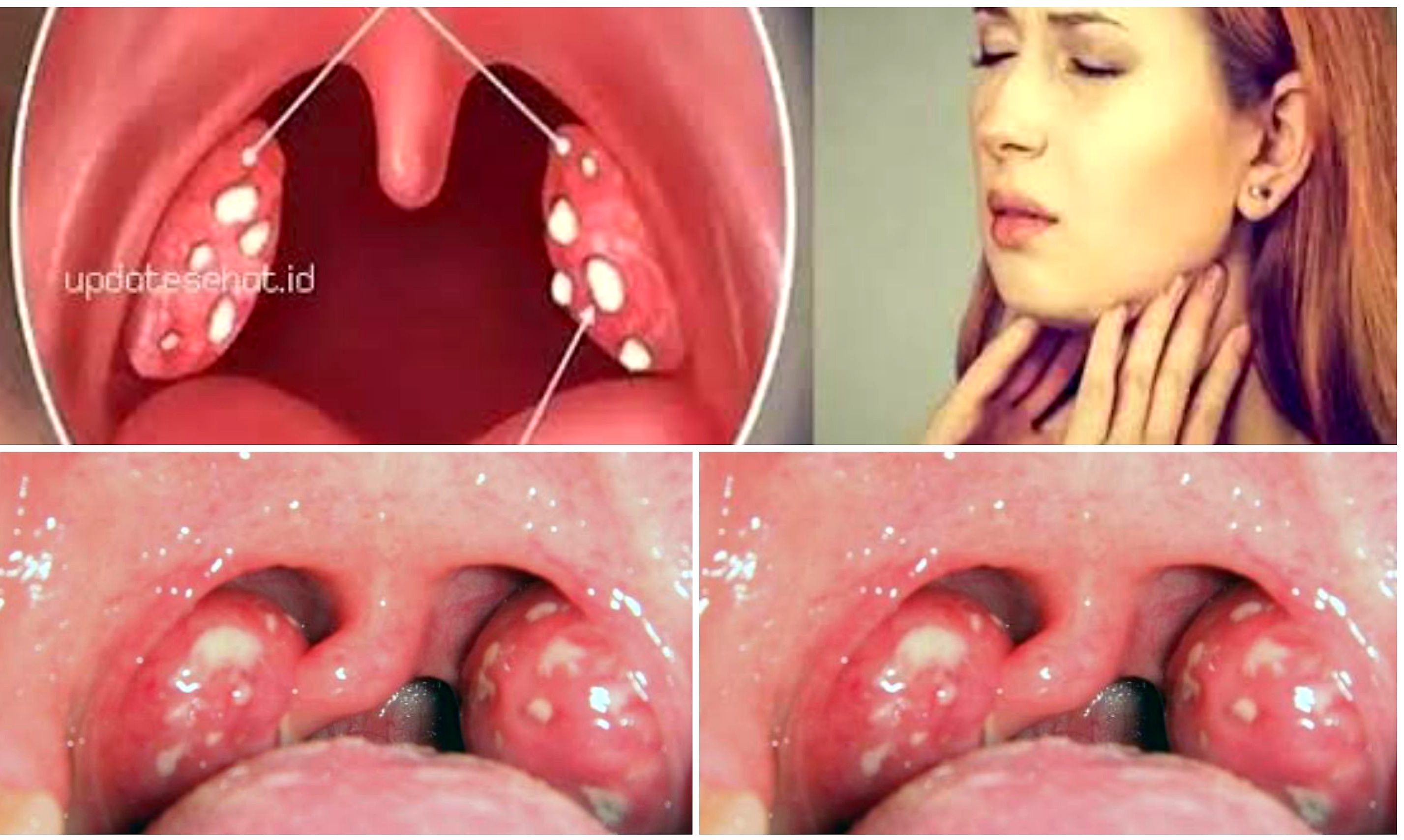 Deteksi Dini Batu Amandel, Penyebab, Gejala dan Cara Penanganannya