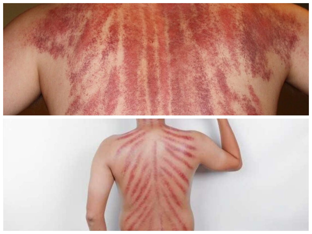 Manfaat Kerokan untuk Tubuh: Bikin Badan Lebih Ringan dan Segar!