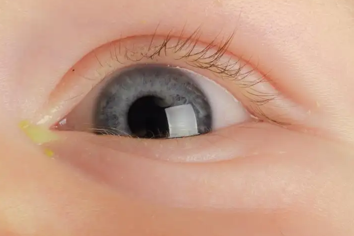 Bunda! Inilah Tips Menyembuhkan Mata Belekan Pada Bayi