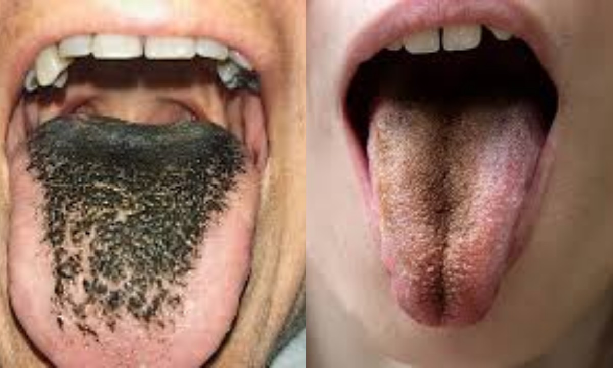  Lidah Menghitam dan Berbulu? Kok Bisa Sih, Simak 6 Penyebab dan Cara Mengatasinya!