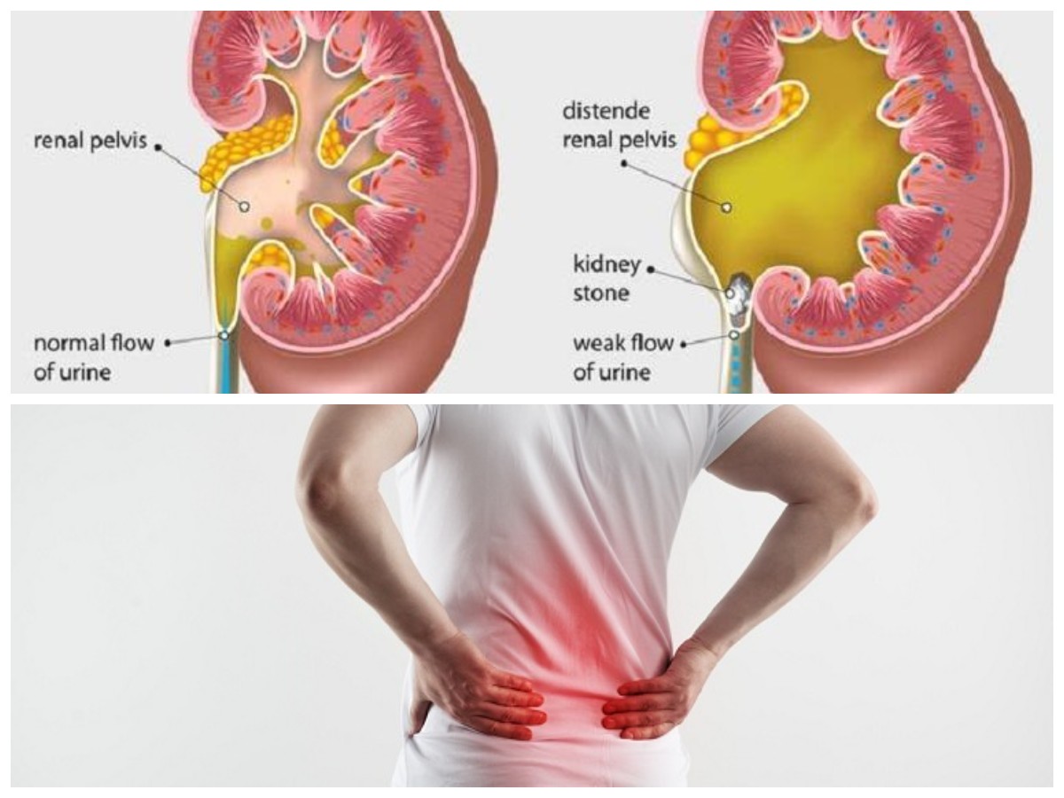 Alasan Mengapa Ginjal Anda Bengkak dan Solusi Mengatasinya 