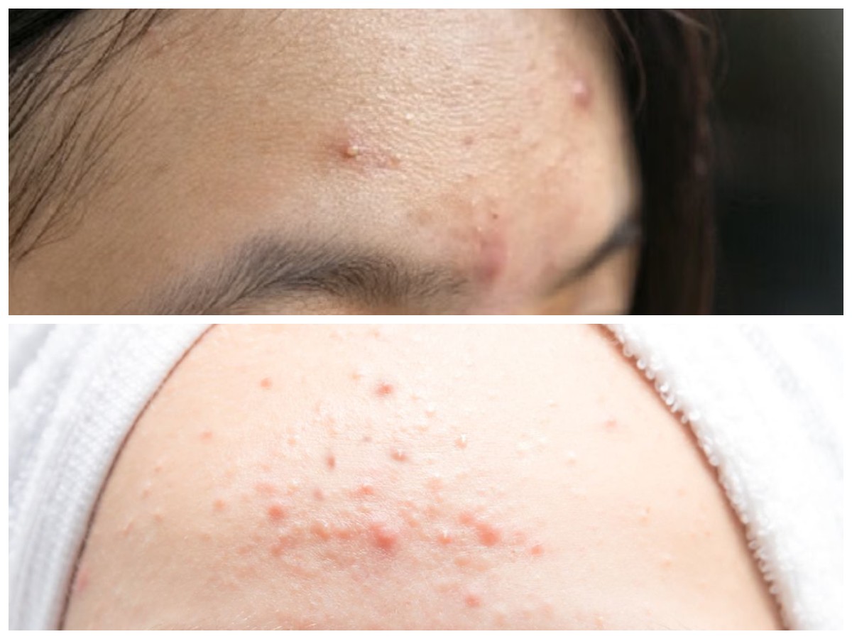 Cara Ampuh Atasi Jerawat di Jidat: Kenali Penyebab dan Tips Menghilangkannya