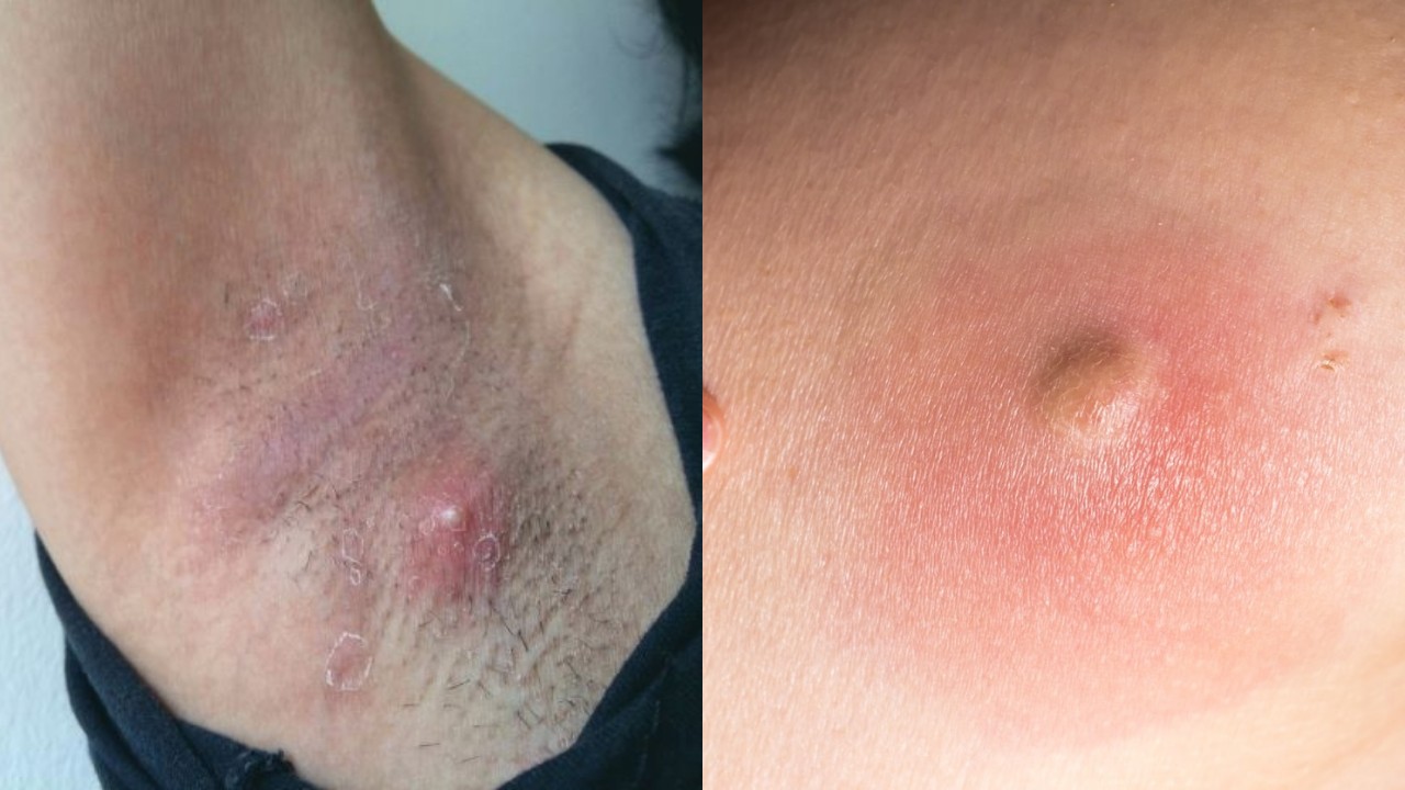 Inilah Penyebab Bisul di Ketiak dan Cara Mengatasinya, Simak Yuk!