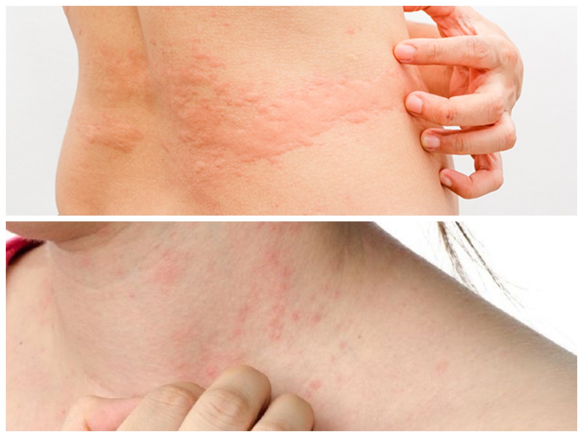 Kulit Gatal dan Ruam Setelah Konsumsi Daging Merah? Waspadai Alerginya dan Simak Cara Mengatasinya!