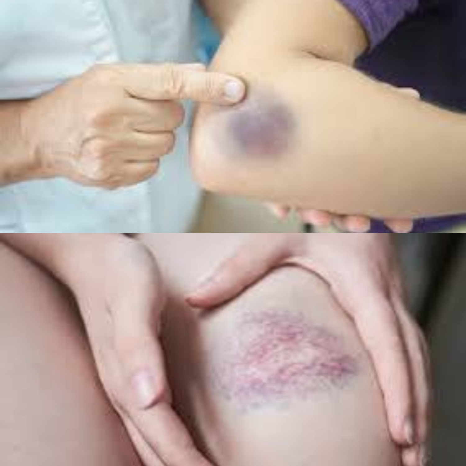 Anda Wajib Tahu! Pertolongan Pertama pada Luka Memar