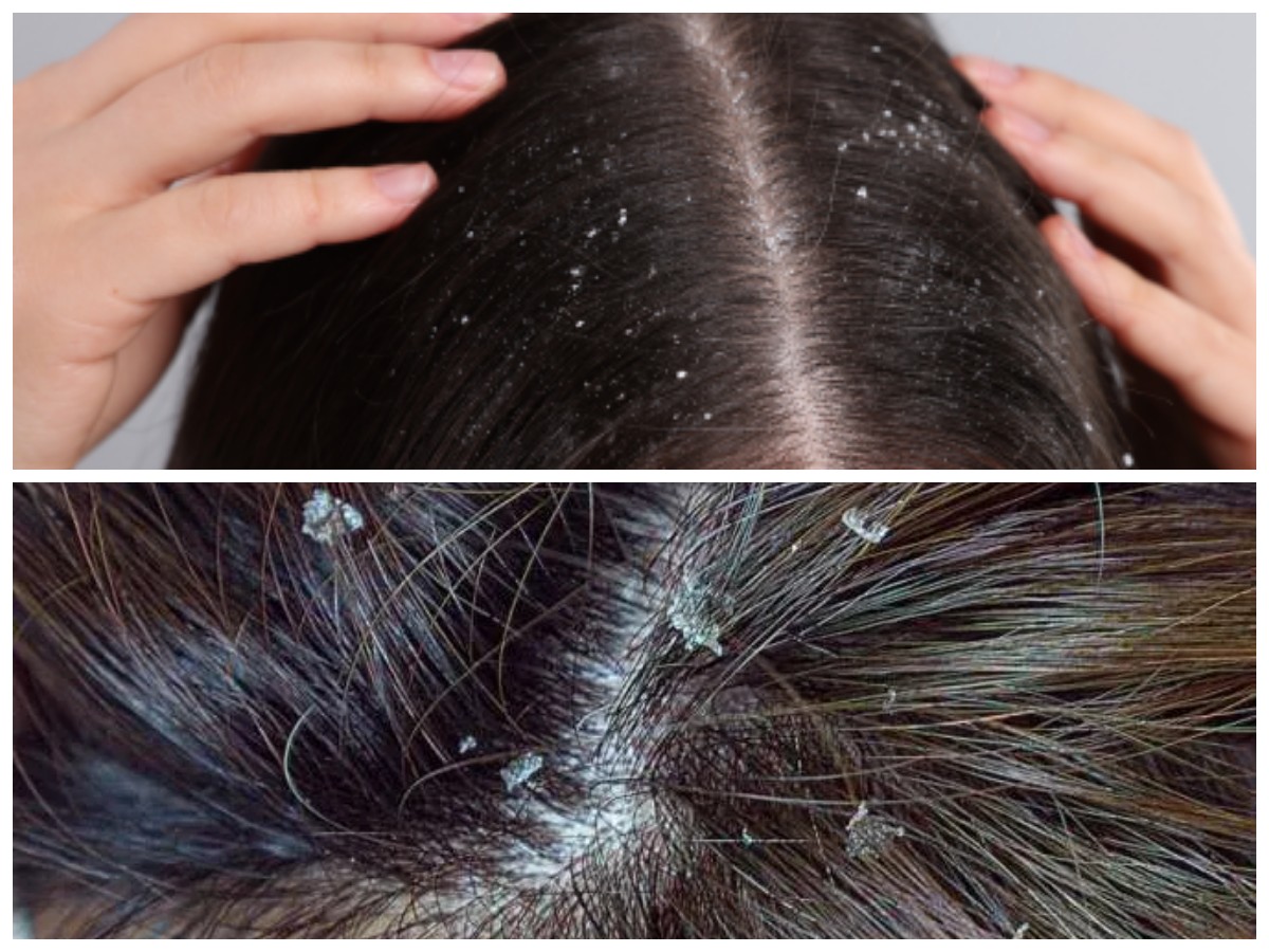 Hilangkan Ketombe Tanpa Ribet: Panduan Praktis Perawatan Rambut Sehari-hari