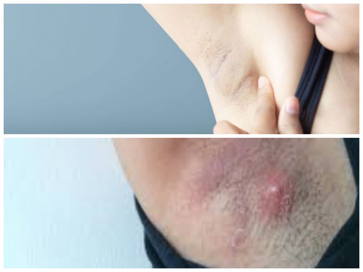 Kenali Penyebab Bisul di Ketiak dan Cara Ampuh Menghindarinya