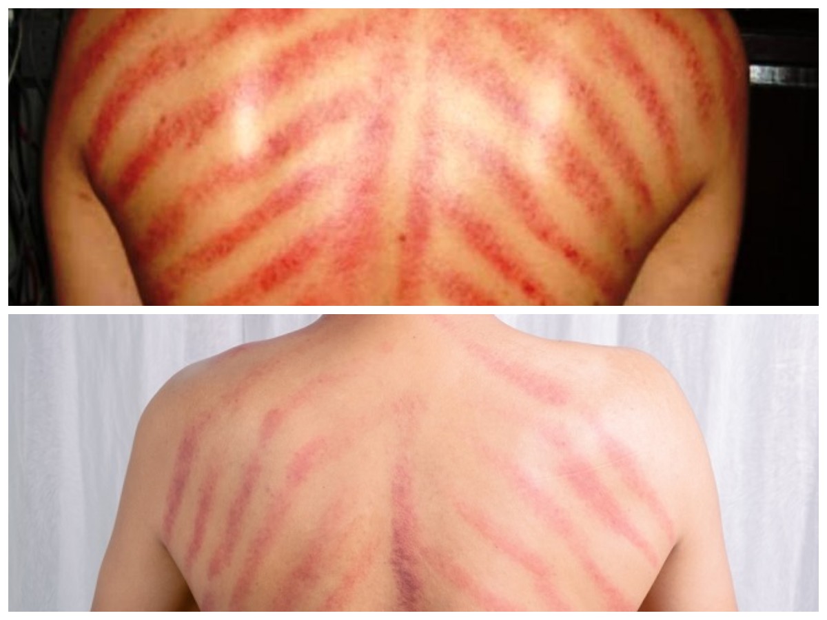 Kenapa Kerokan Bikin Tubuh Segar? Simak Penjelasannya!