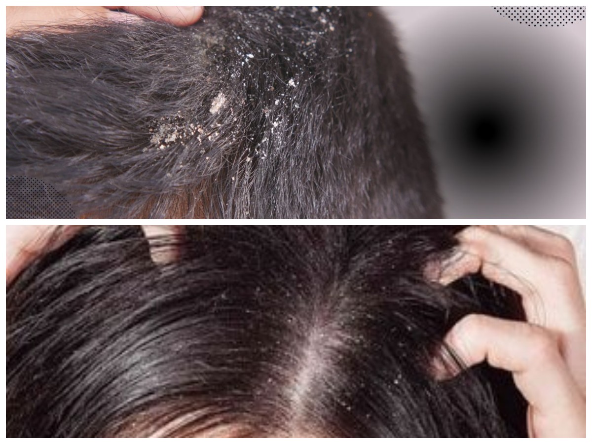 Bebas Ketombe! Ini 5 Cara Ampuh Atasi Masalah Kulit Kepala Secara Alami