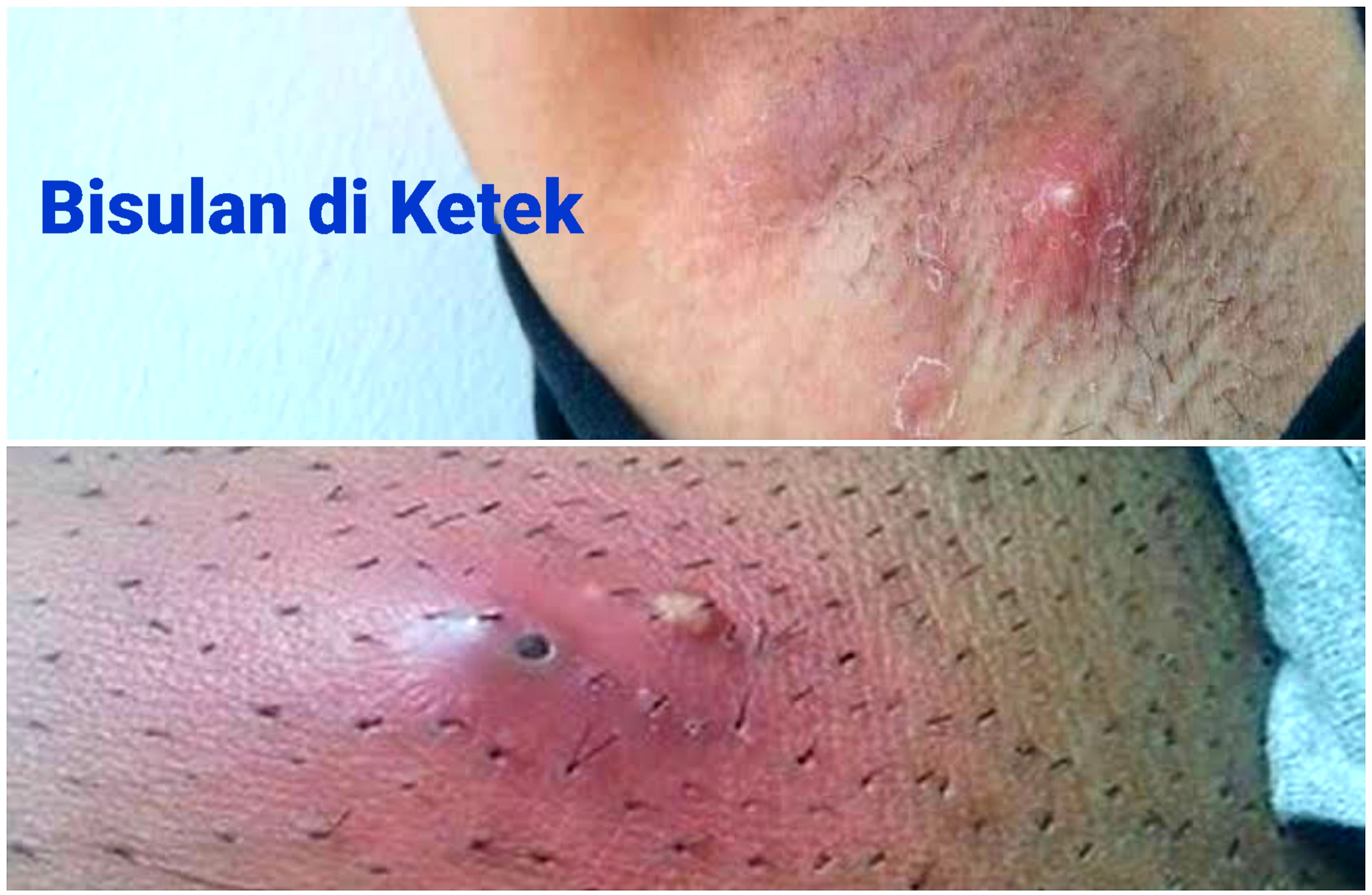 Bisul di Ketiak Mengganggu? Atasi dengan Pengobatan Ini