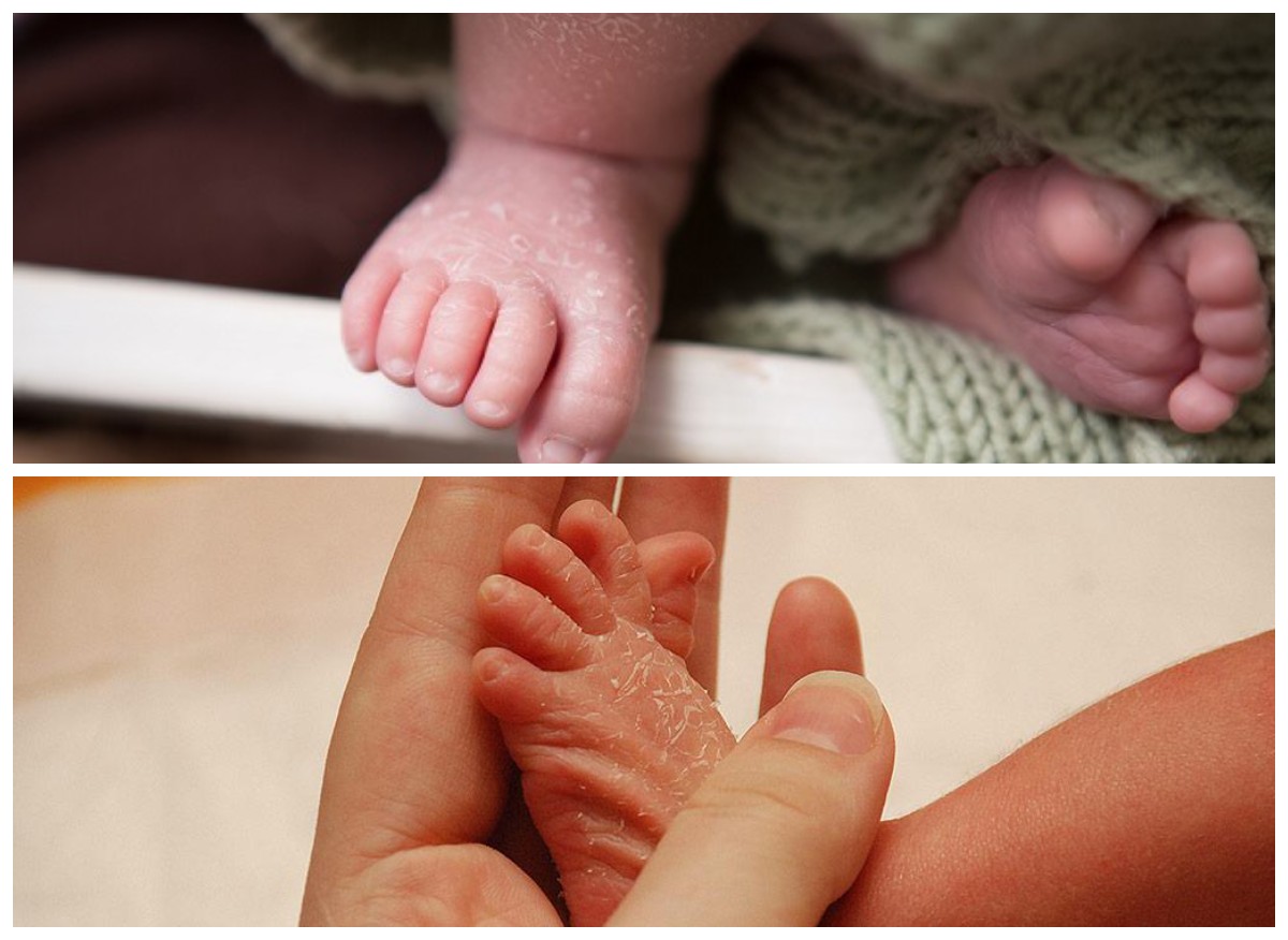 8 Cara Efektif Merawat Kulit Bayi yang Mengelupas