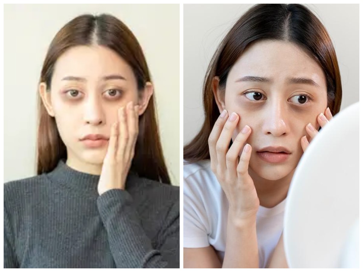 Mata Panda? Iniilah 8 Tips Mengatasinya serta Penyebab Mata Panda!