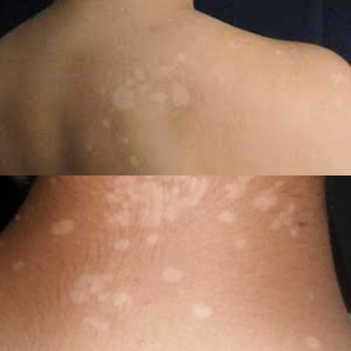 Penyebab Panu dan Cara Mencegahnya Yuk Simak!