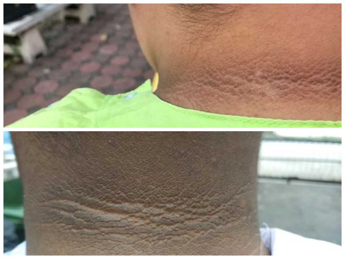 Leher Tampak Gelap? Ini Faktor Penyebab dan Solusi Alami Maupun Medis yang Efektif!