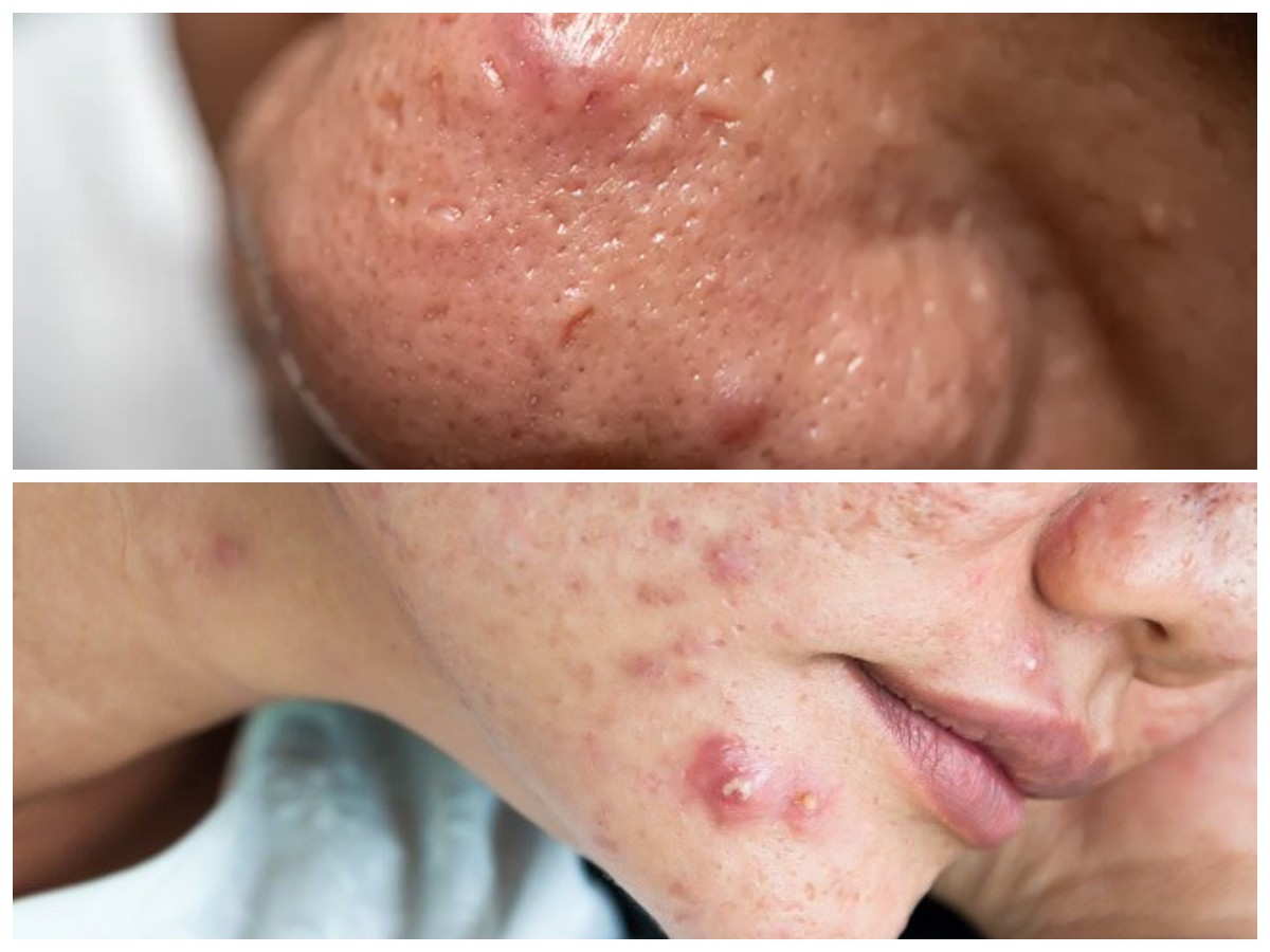 7 Strategi Efektif untuk Mengatasi Jerawat Batu Secara Cepat dan Aman