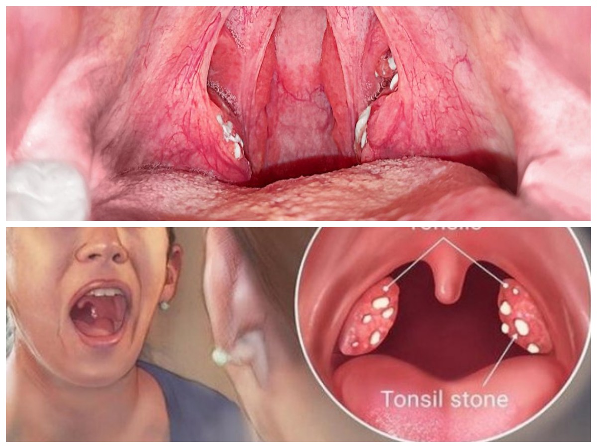 Mengenal Penyebab Batu Amandel dan Tips Ampuh untuk Mencegahnya