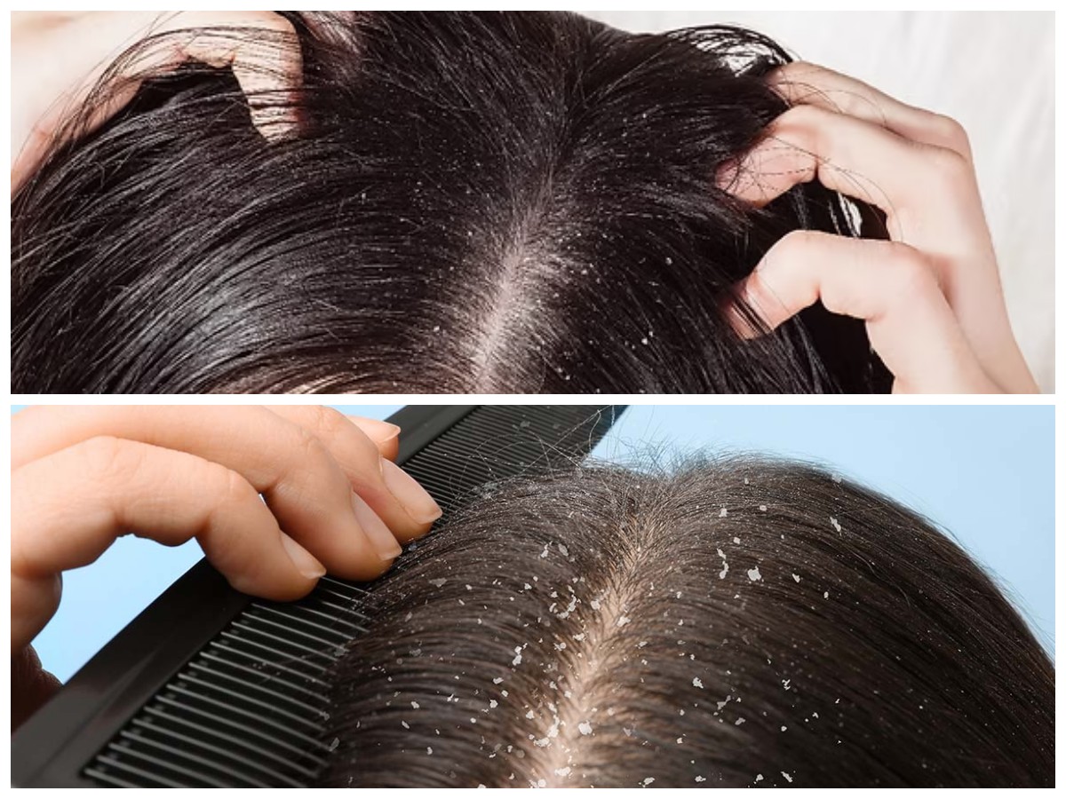 7 Langkah Praktis untuk Membasmi Ketombe Membandel di Kepala