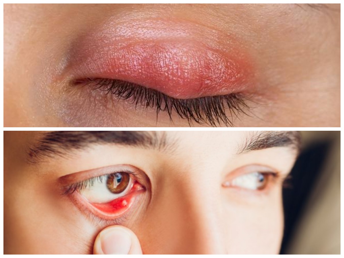 Mata Terdapat Benjolan? Ini Penyebab dan Cara Mencegahnya