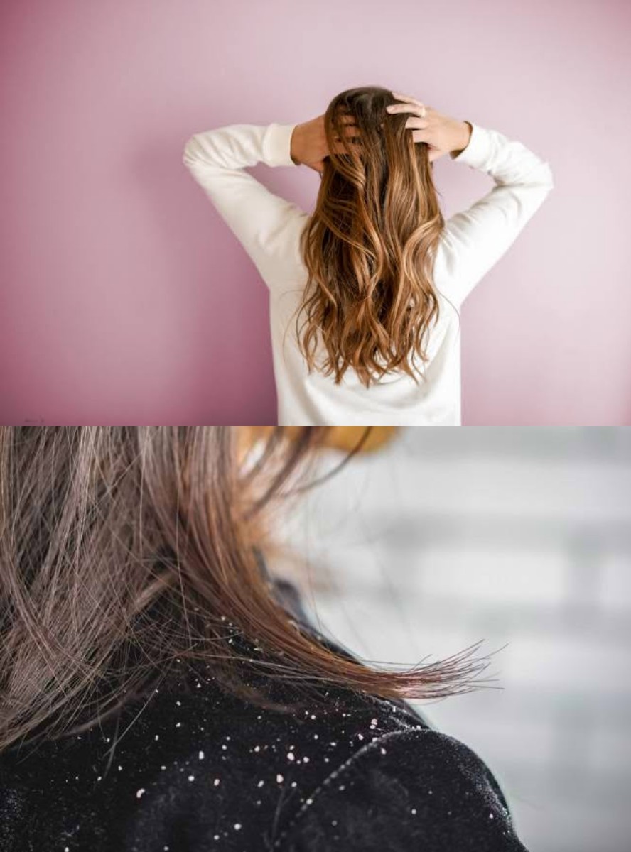 Sudah Ganti Shampoo Empat Kali, Tapi Ketombe Masih Setia