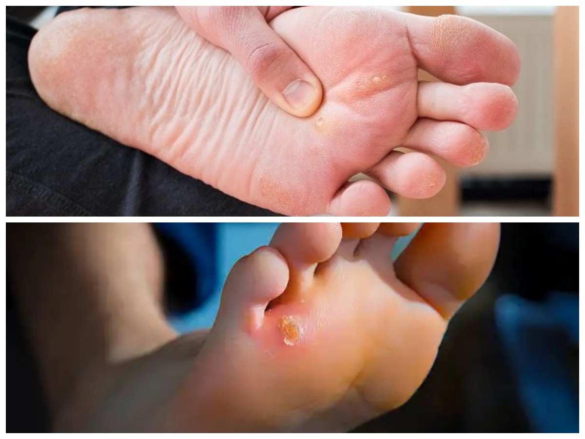 Mengenal Mata Ikan: Penyebab, Gejala, dan Cara Mengatasinya dengan Benar