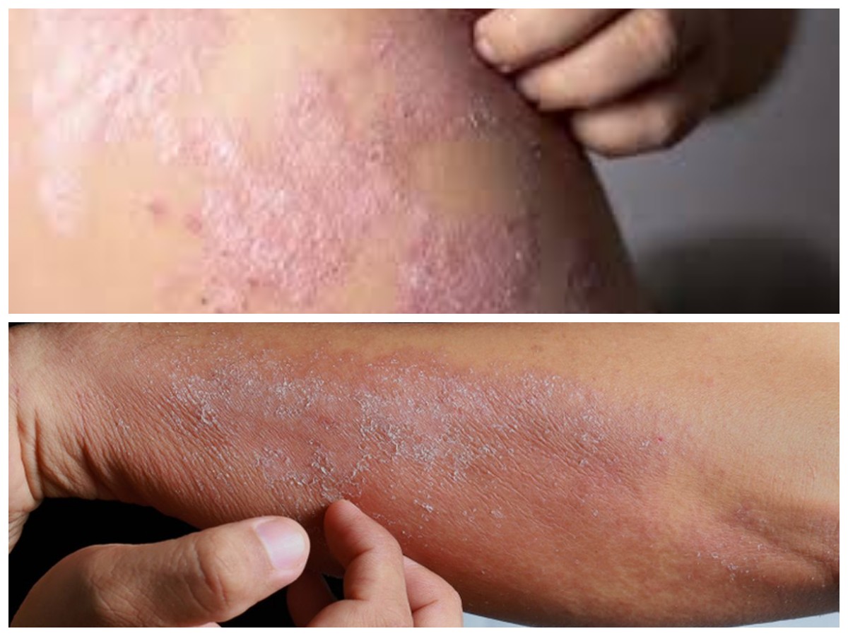 5 Jenis Infeksi Kulit Akibat Bakteri dan Cara Mengatasinya