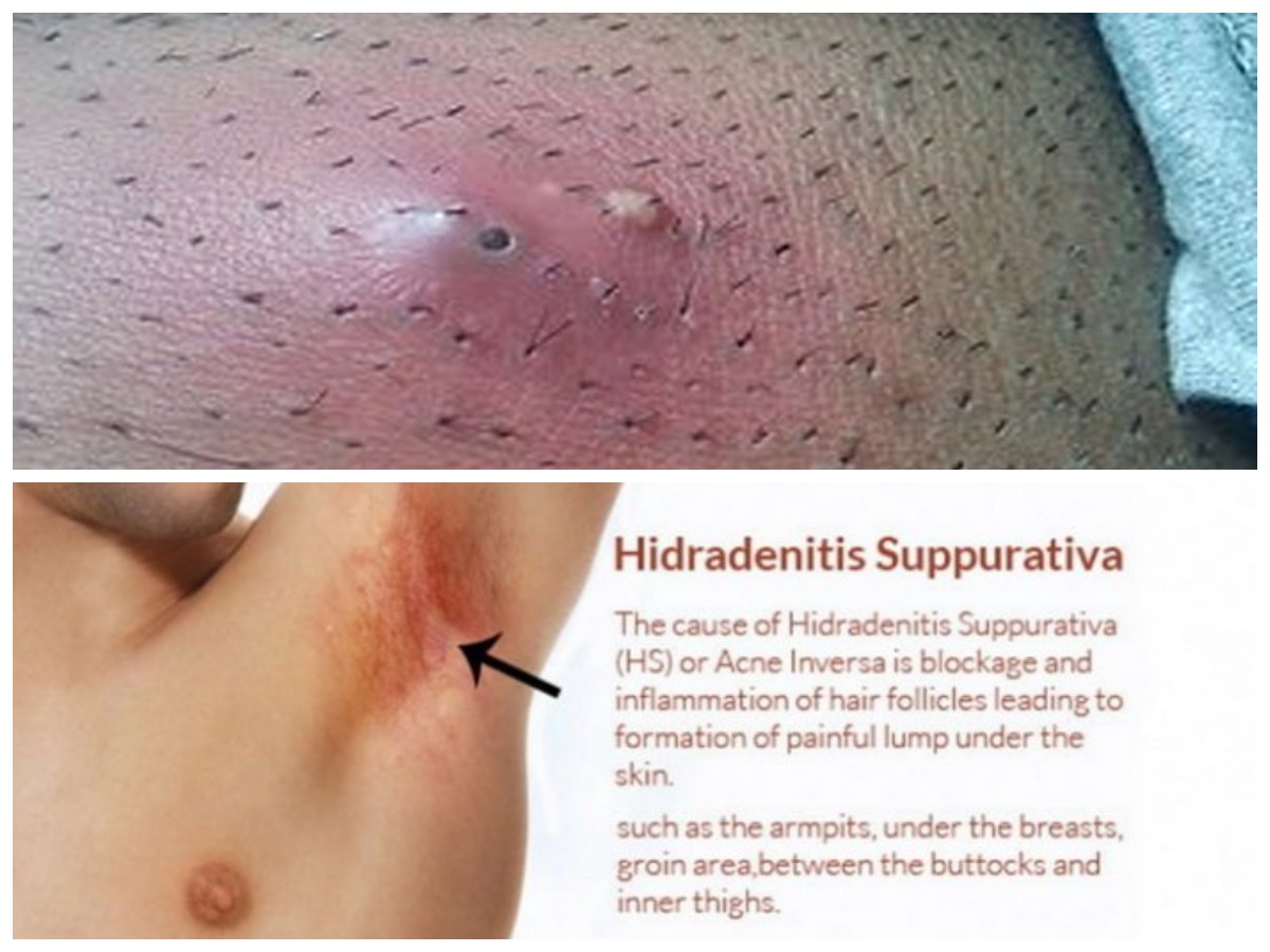 Kenali Penyebab Bisul di Ketiak dan Cara Efektif Mengatasinya