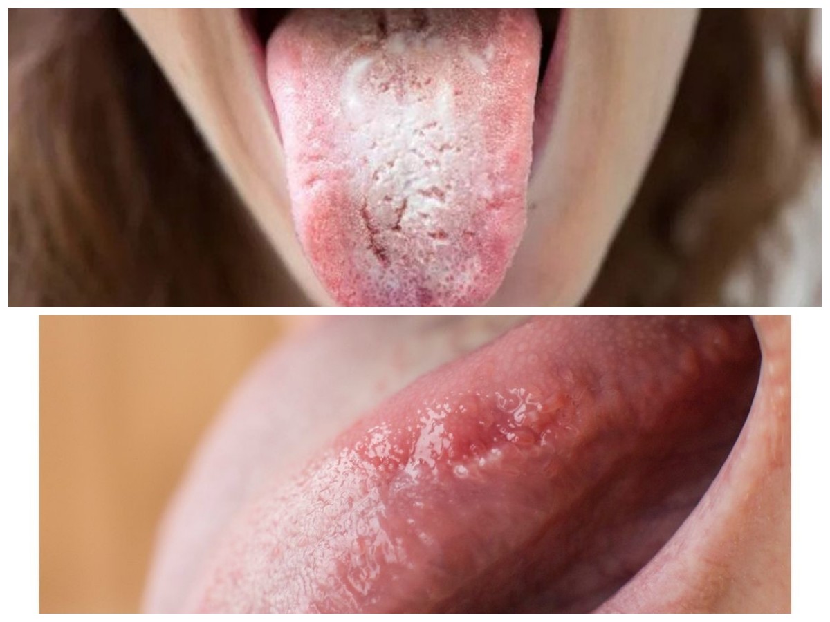 8 Cara Efektif Mengatasi Radang Lidah Secara Alami dan Medis