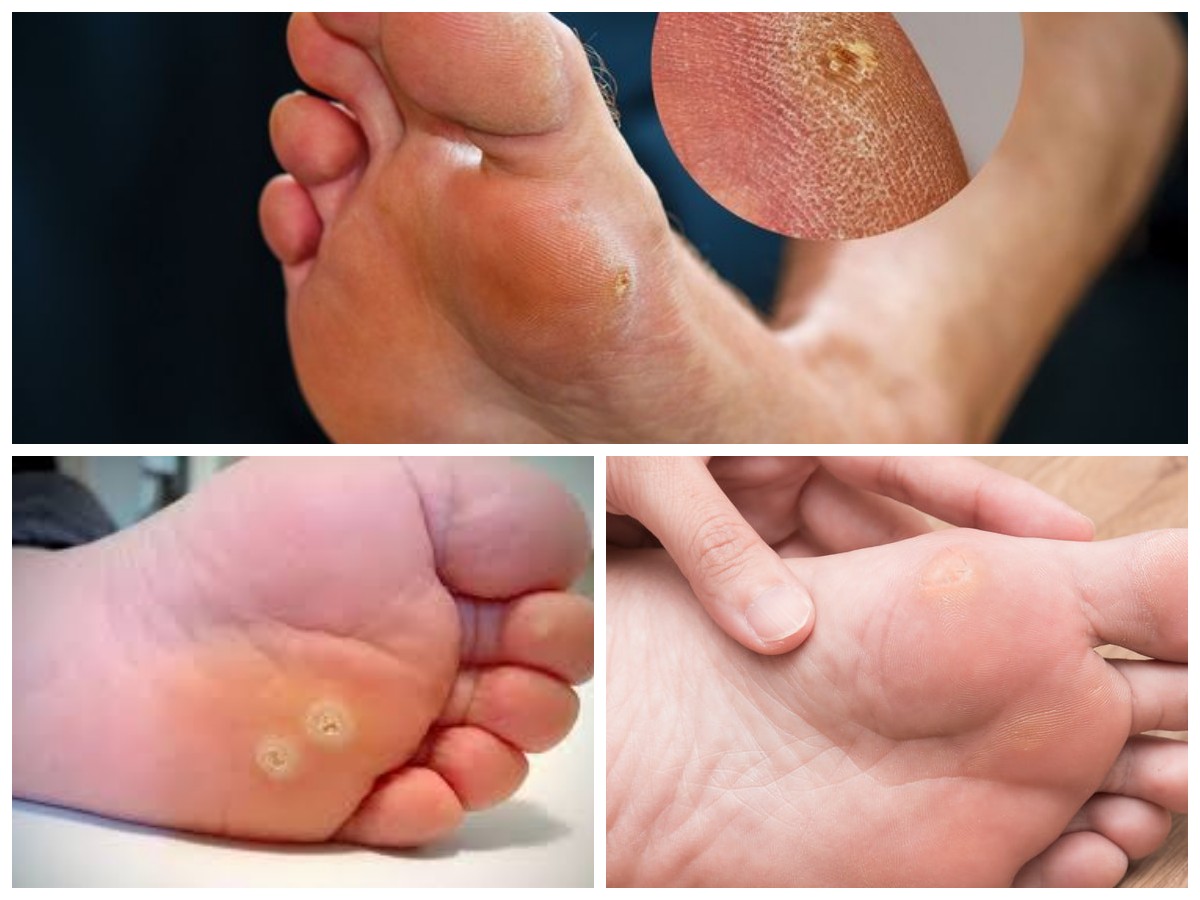 Serupa Tapi Tak Sama: Ini Bedanya Mata Kapalan dan Mata Ikan, Atasi dengan Cara yang Tepat!