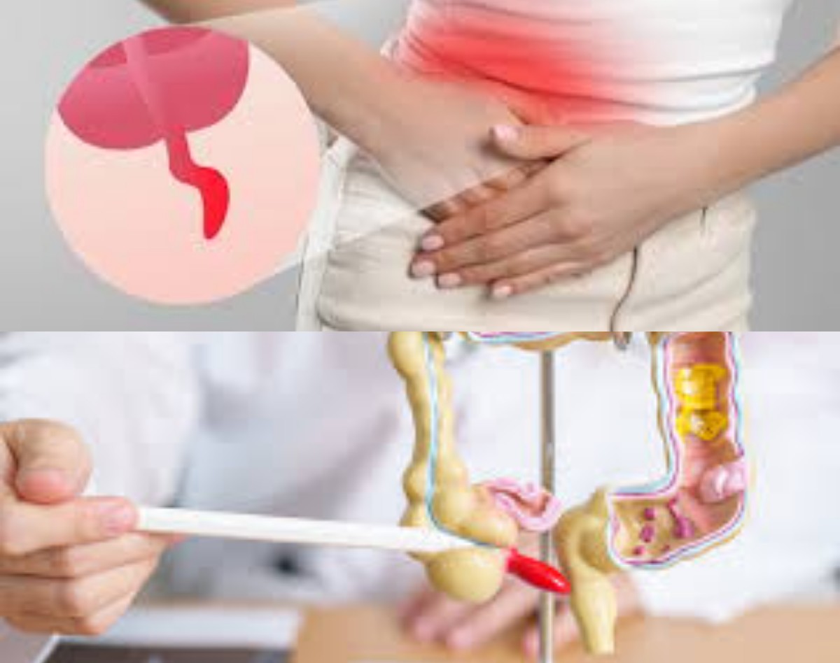 Kenali Gejala Usus Buntu: Pentingnya Deteksi Dini untuk Mencegah Komplikasi Serius dan Penanganan yang Tepat