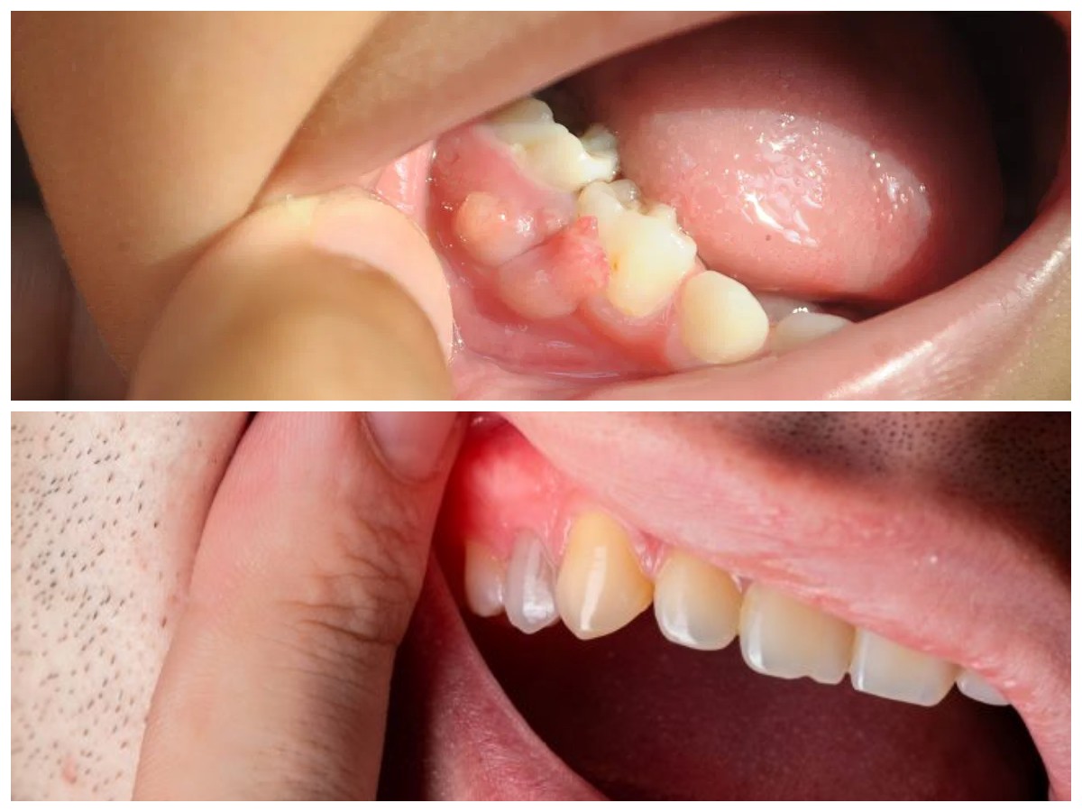 Jangan Disepelekan! Kenali Penyebab Gusi Bengkak Berdarah dan Cara Ampuh Mengobatinya