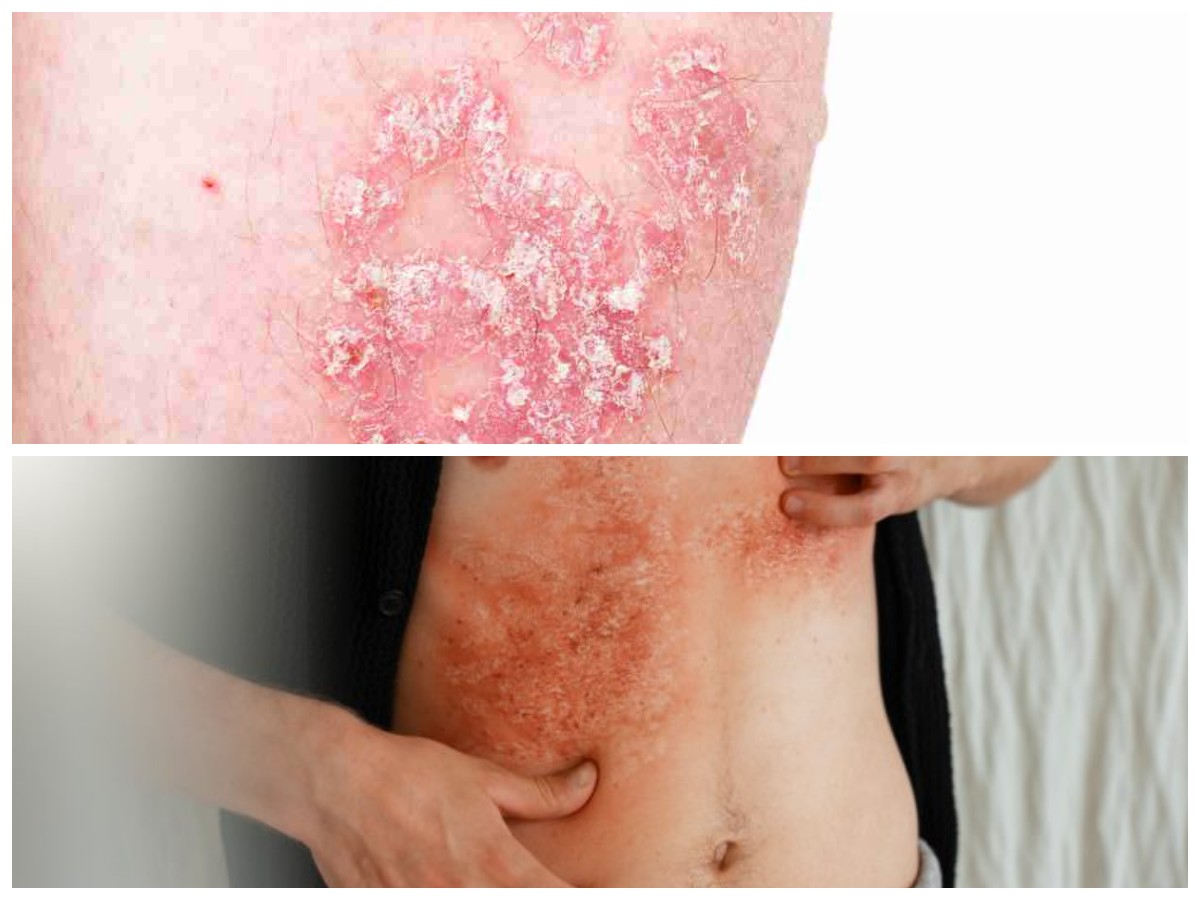 Jangan Abaikan! Ini 7 Penyakit Kulit yang Sering Terjadi dan Cara Penanganannya