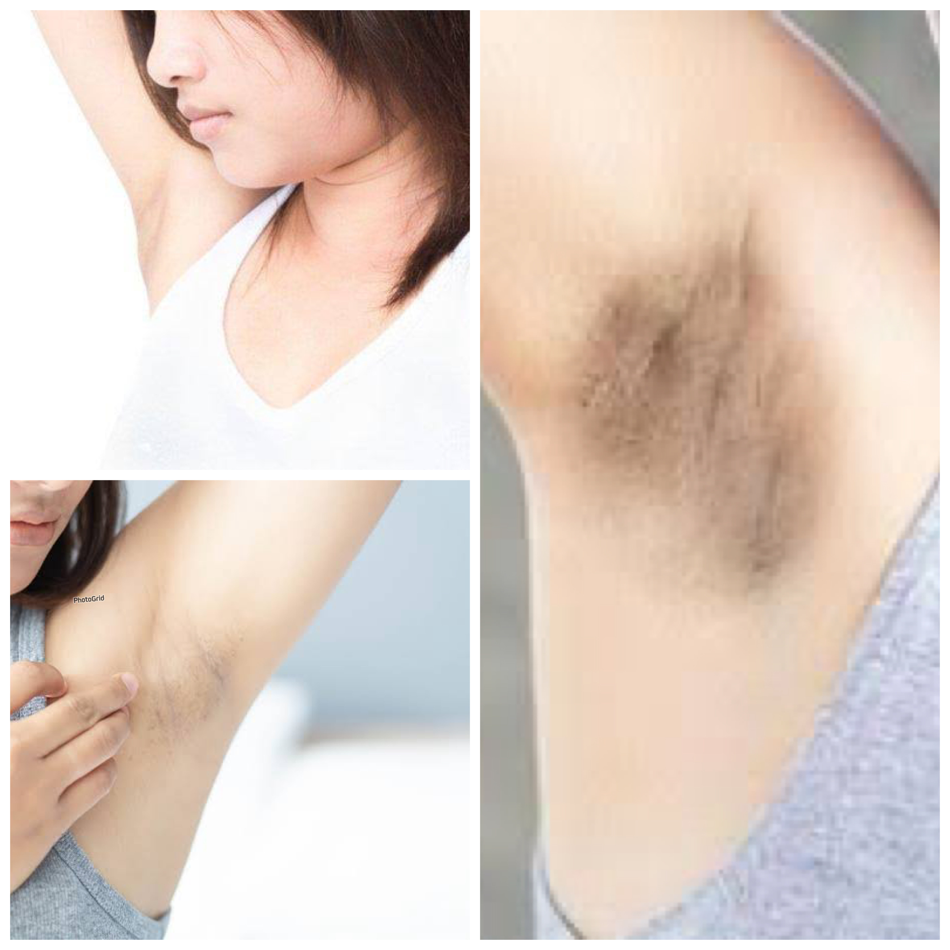 7 Tips Mengatasi Ketiak Hitam dengan Ampuh: Solusi Alami dan Medis untuk Kulit Lebih Cerah dan Percaya Diri!