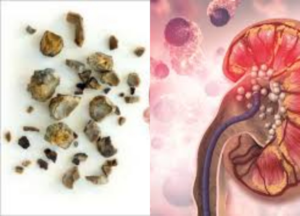 Waspada! Terlalu Sering Makan Asin dapat Menyebabkan Batu Ginjal, Simak Penyebab dan Cara Mencegahnya!