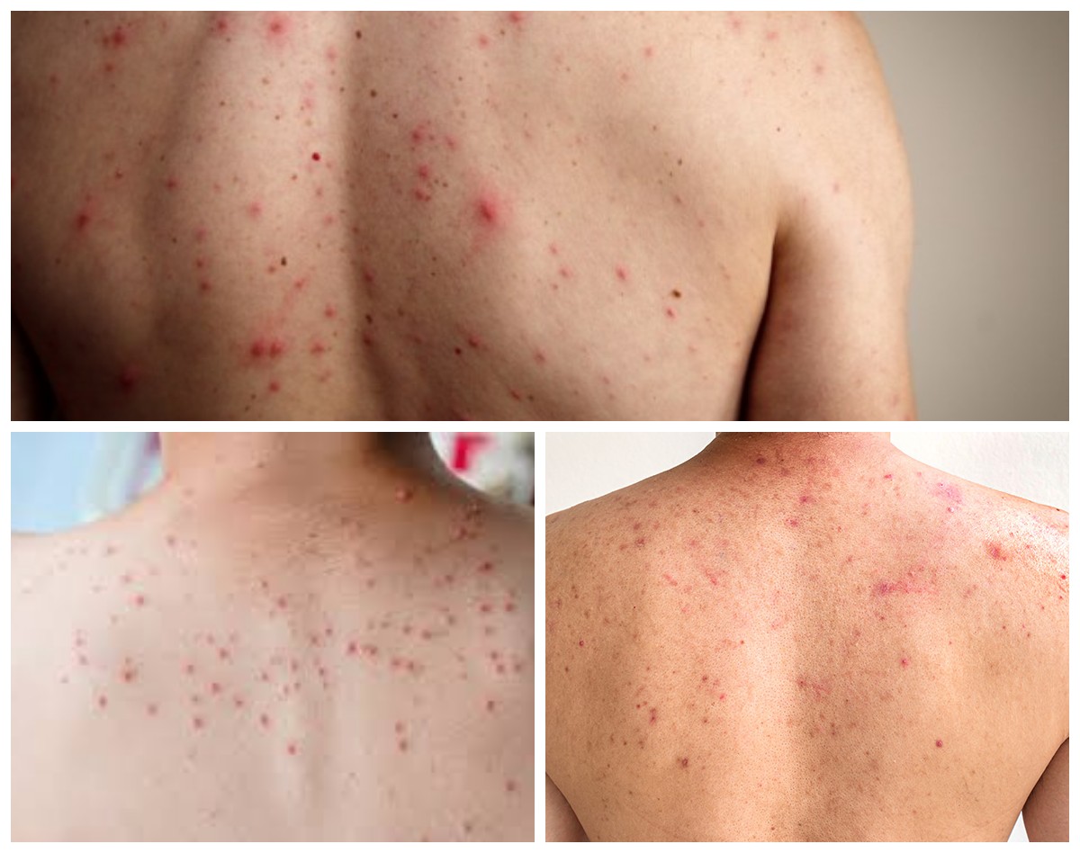 Jerawat di Badan: Penyebab Utama dan Cara Efektif Menghilangkannya Secara Tuntas!