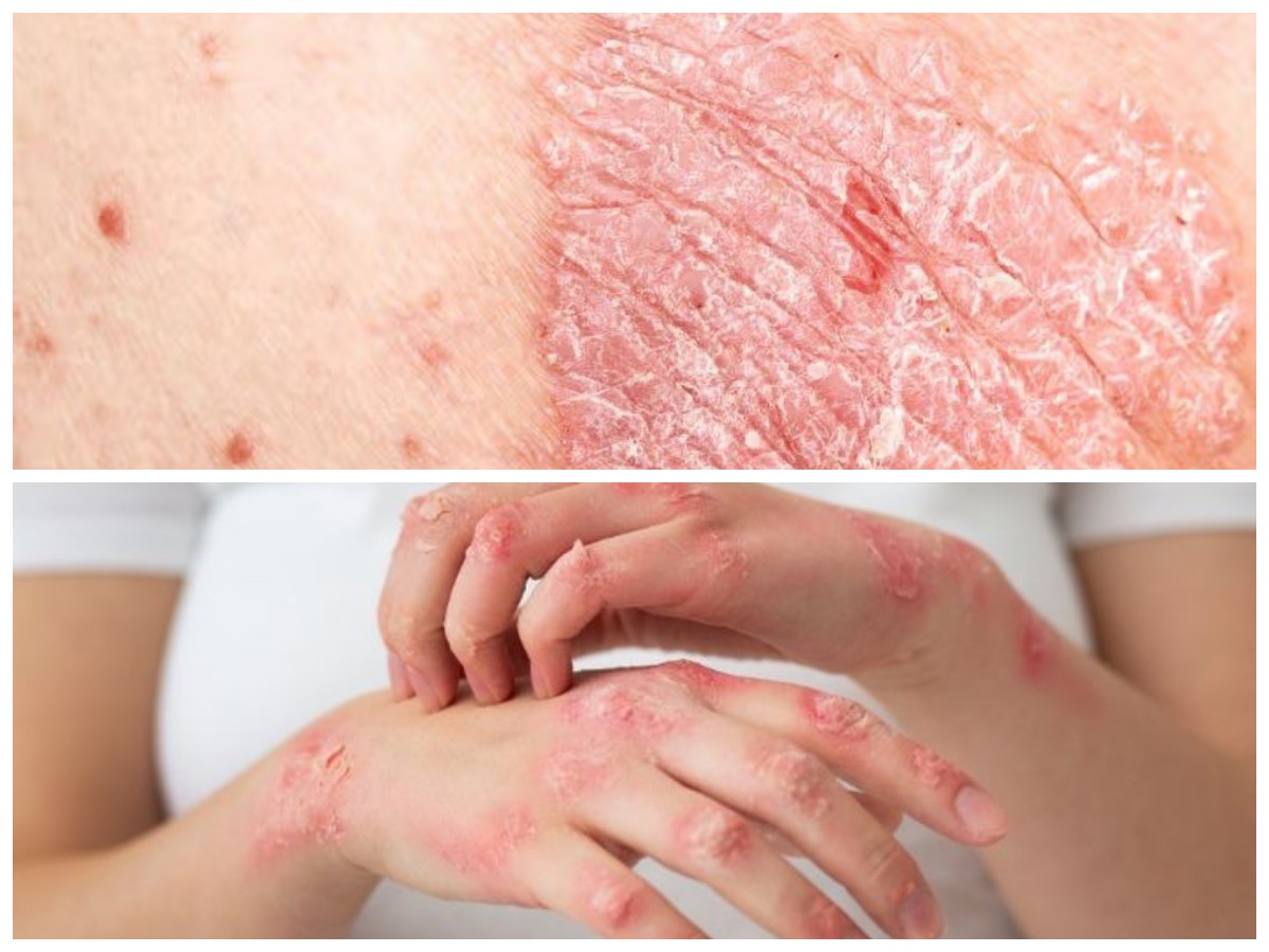  Waspadai! Ini 6 Penyakit Kulit yang Sering Terjadi dan Cara Tepat Mengatasinya