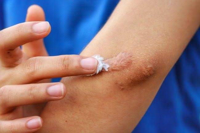 Keloid Bikin Minder? Begini Atasi Bekas Luka Agar Tak Berbekas