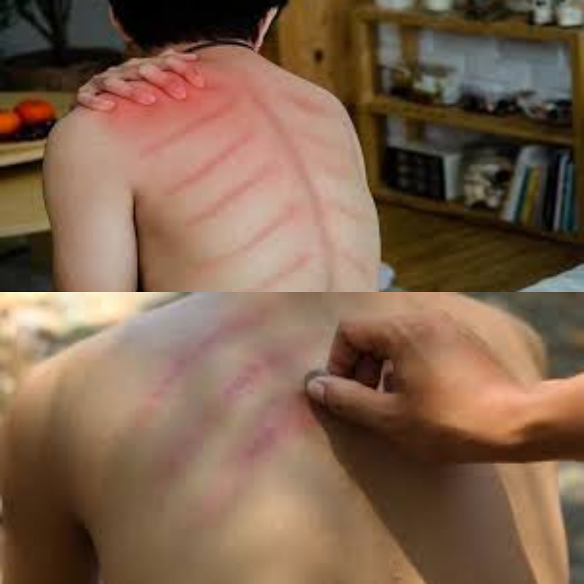 Ini Alasan Tubuh Lebih Segar Setelah Kerokan!