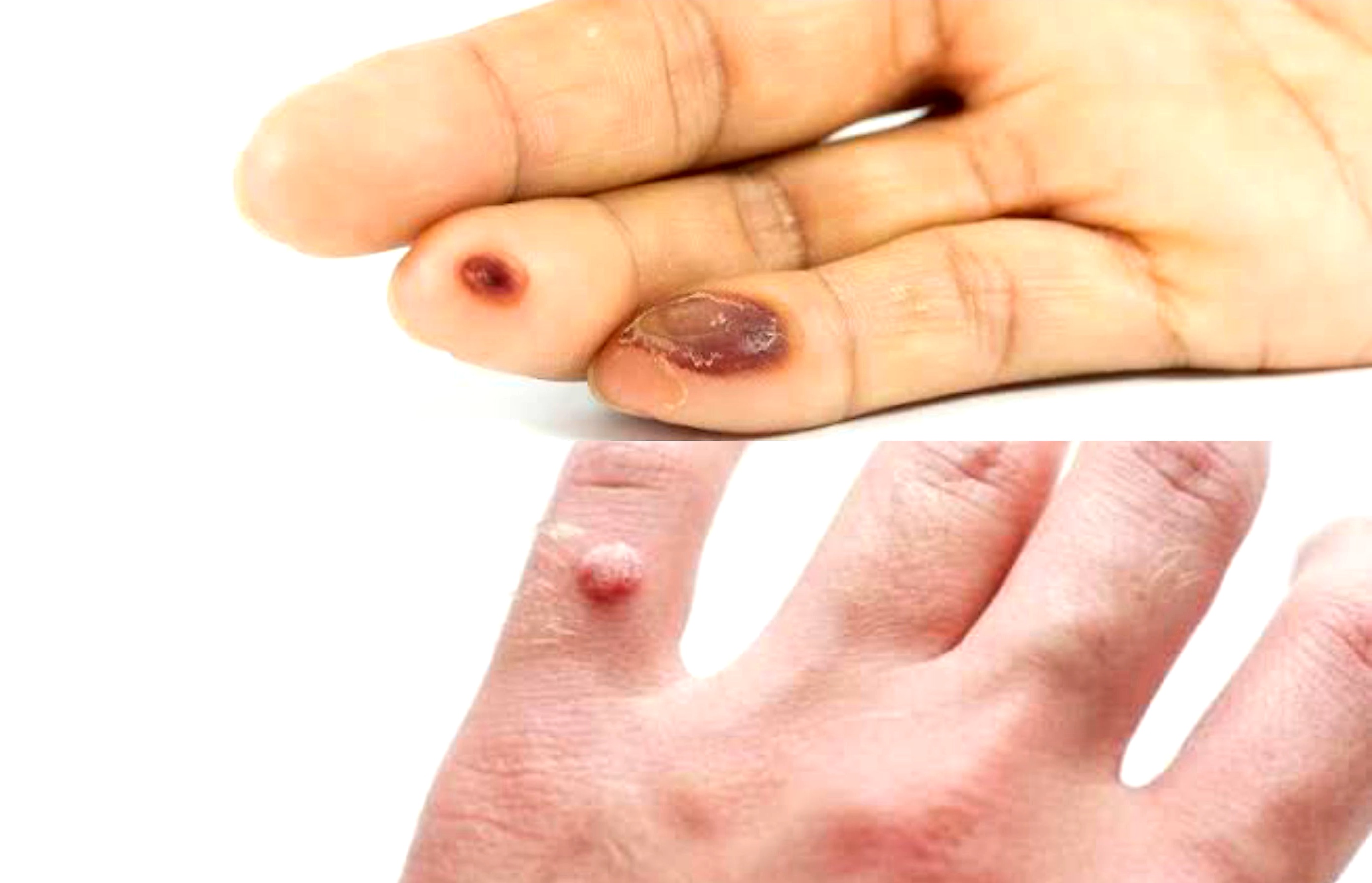 Atasi Kapalan dan Mata Ikan di Tangan dengan Mudah