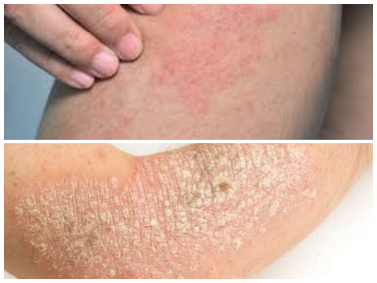 Waspada! Kulit Kering dan Gatal Bisa Menjadi Sinyal 8 Penyakit Serius Ini