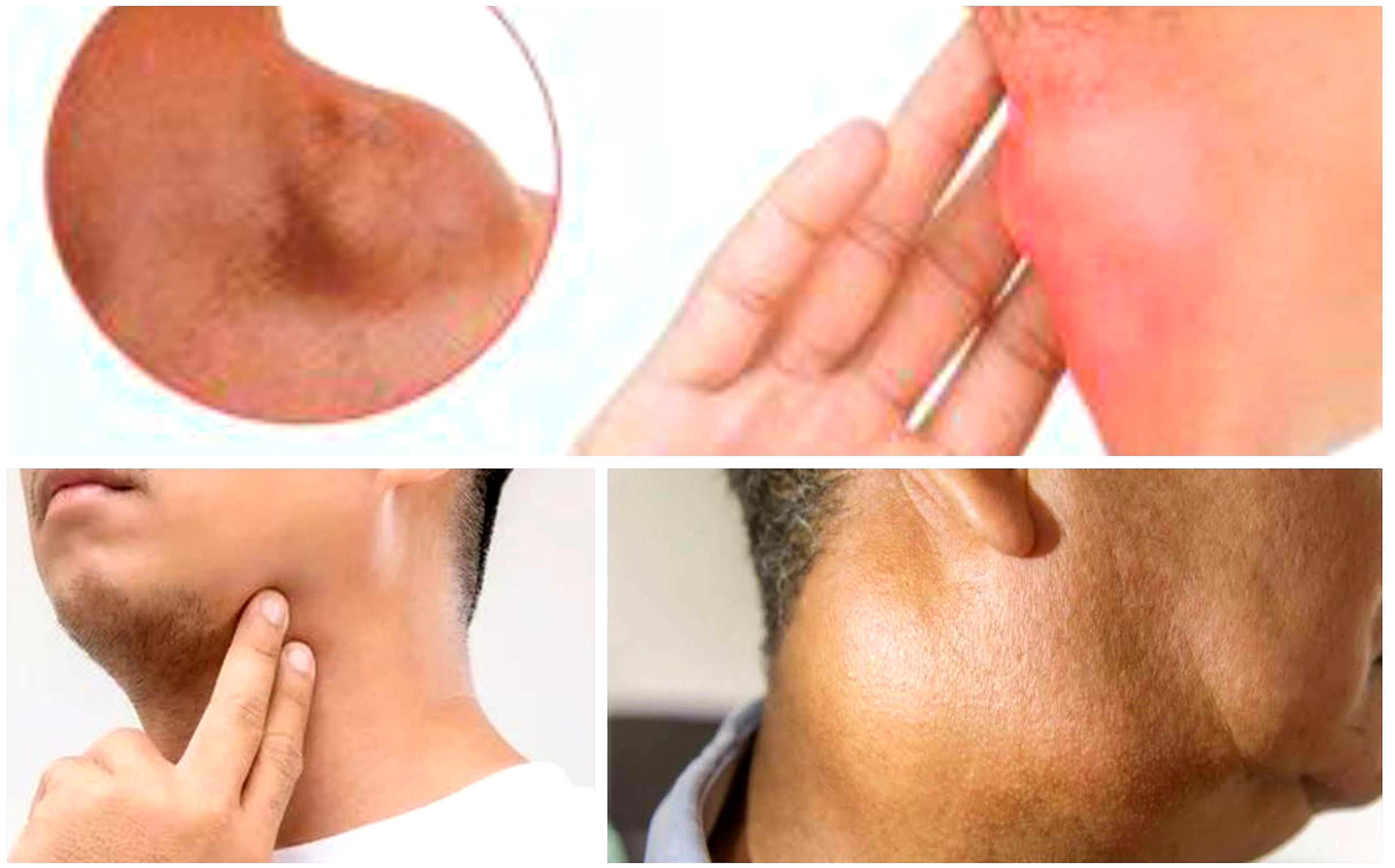 Getah Bening Langsung Kempes. Lakukan Langkah-langkah Pengobatan Ini