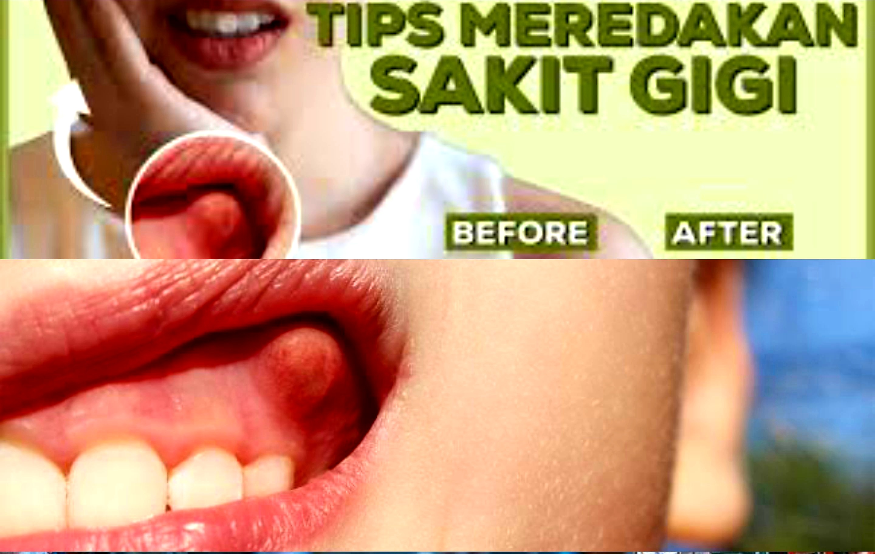 Ngga Pake Lama! Penyebab dan Atasi Gusi Bengkak Berdarah