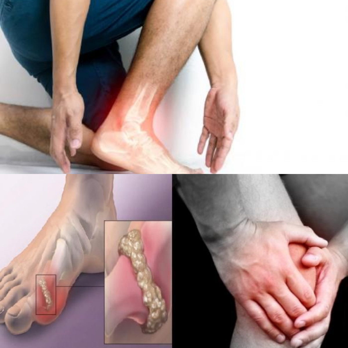 IniLah Wajib Anda Tahu Kenali Gejala Asam Urat dan Cara untuk Mengobatinya!