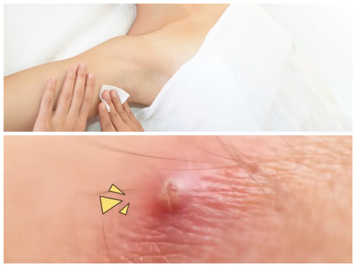 Waspadai! Ini Penyebab Bisul di Ketiak dan Cara Efektif Mengatasinya