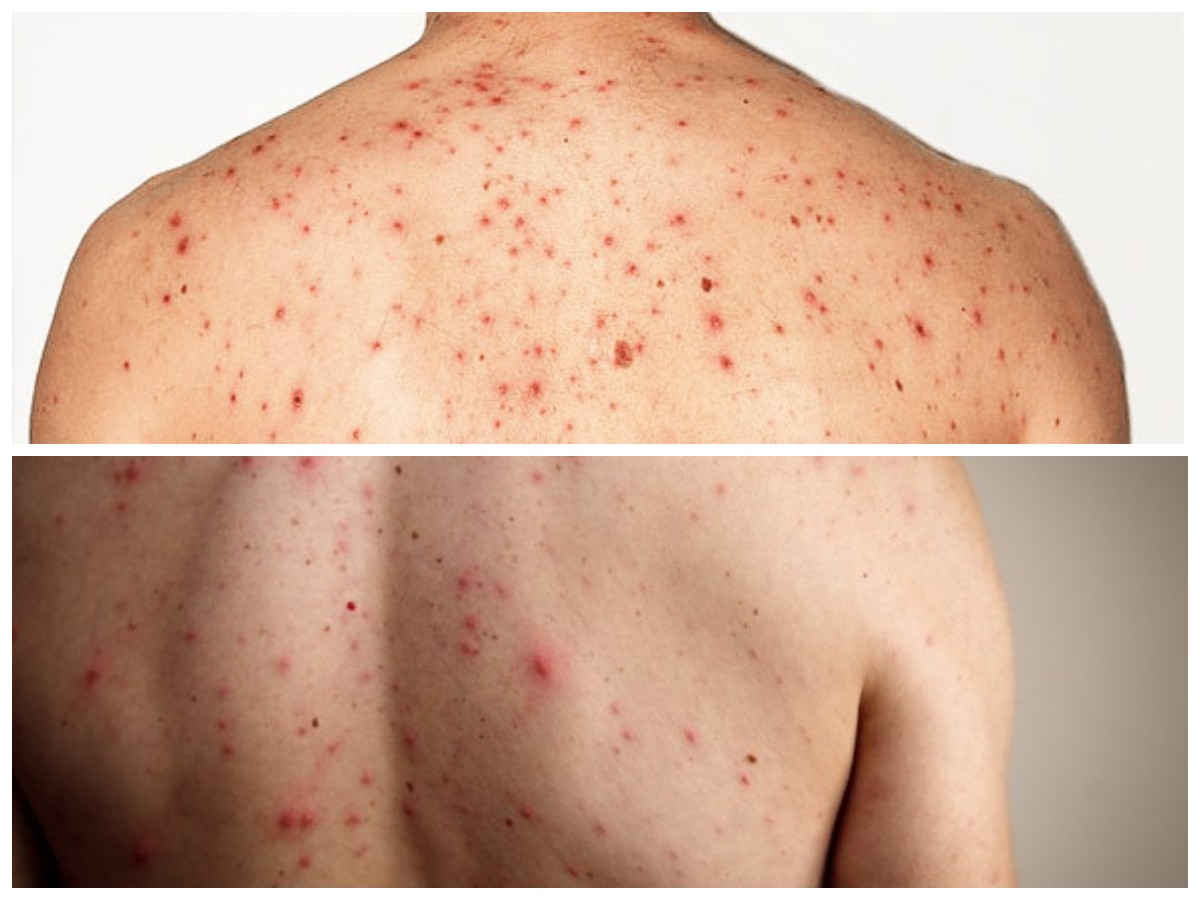 Mengapa Jerawat Muncul di Badan? Ini Penjelasan dan Solusi Efektifnya!