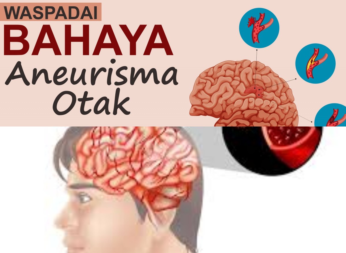 Aneurisma Otak: Bahaya Mengancam Nyawa yang Tersembunyi, Apa Itu dan Bagaimana Cara Mencegahnya