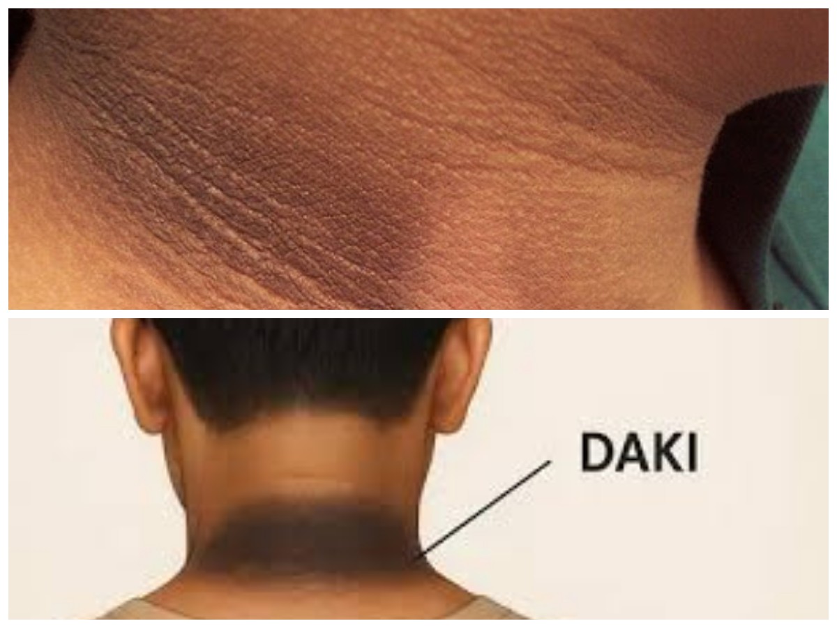 Penyebab Leher Hitam yang Jarang Disadari dan Cara Menghilangkannya dengan Cepat!