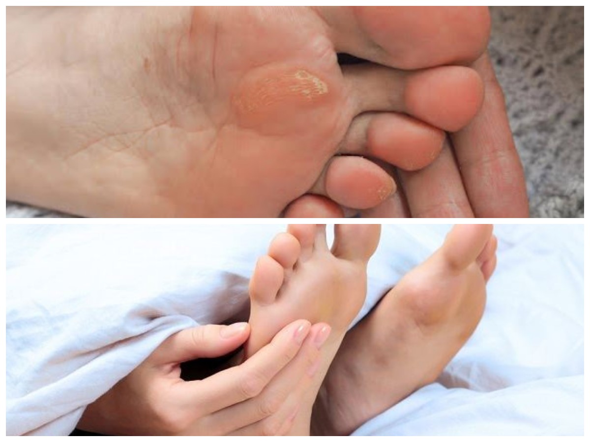 Penyebab Telapak Kaki Gatal dan Cara Efektif Mengatasinya