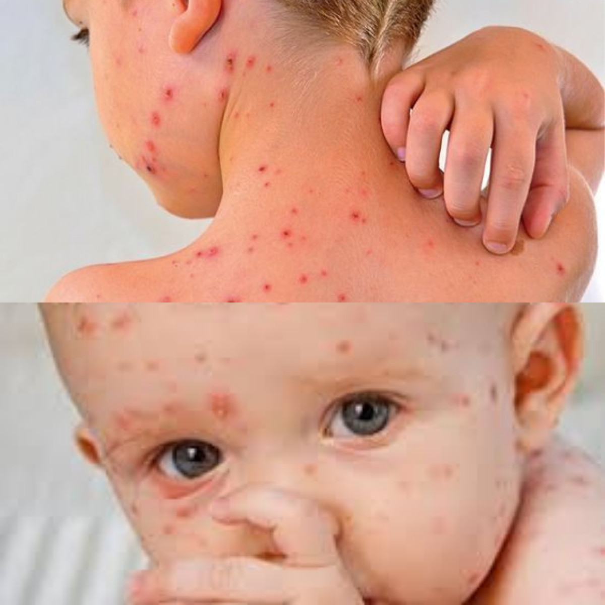 Ciri-Ciri Cacar Air yang Perlu Dikenali dan Diwaspadai!