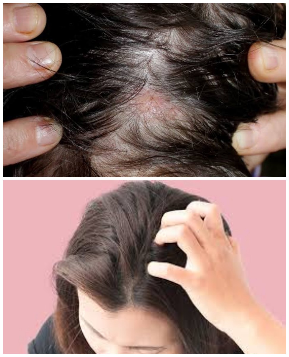 Gatal di Kulit Kepala Tapi Bukan Ketombe